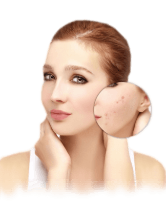How To Reduce Acne Scars In Just 1 Month