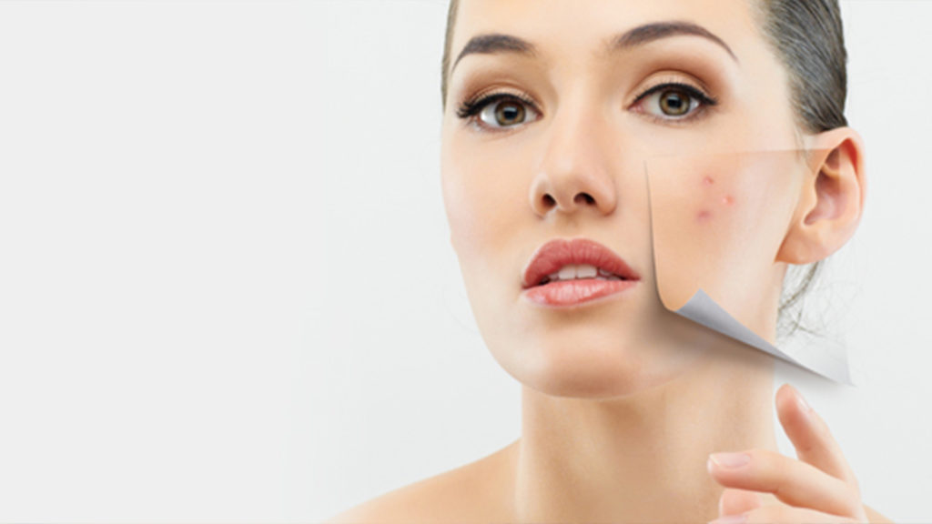 Acne and Isotretinoin for Acne Treatment