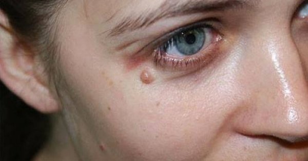 Don’t Be A Worry Wart: Undergoing Wart Removal Treatment In Dubai